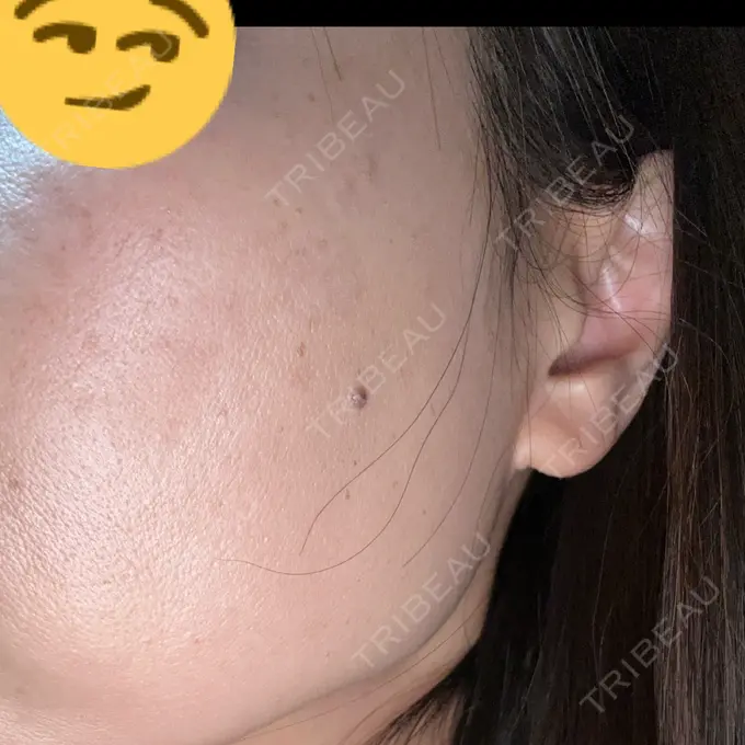 シミ取りレーザー さっぽろ美容クリニック DAY 13 メイン用