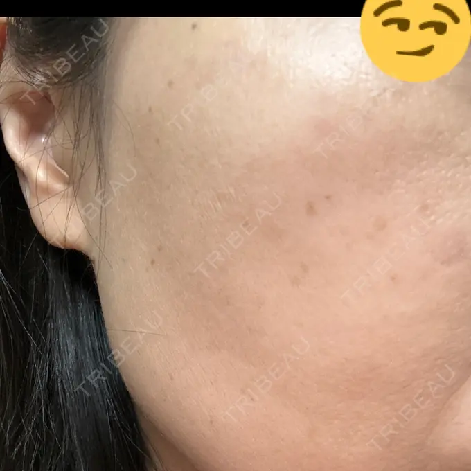 シミ取りレーザー さっぽろ美容クリニック DAY 13 メイン用