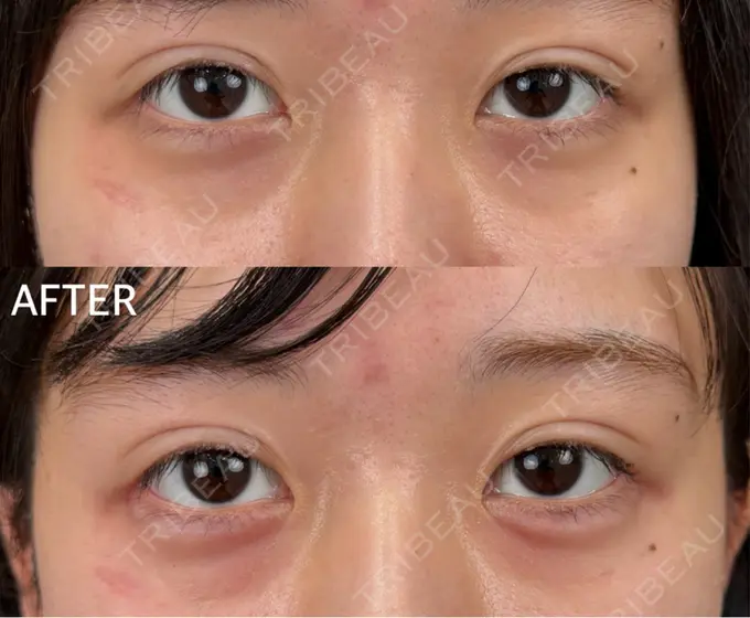 ヒアルロン酸注入（涙袋） AI Beauty Clinic （エーアイ美容クリニック） AFTER メイン用