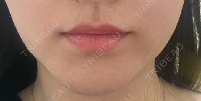 ヒアルロン酸注入（唇） / ボトックス（口角） / インモード 東京美容皮膚科アロエクリニック池袋 AFTER メイン用
