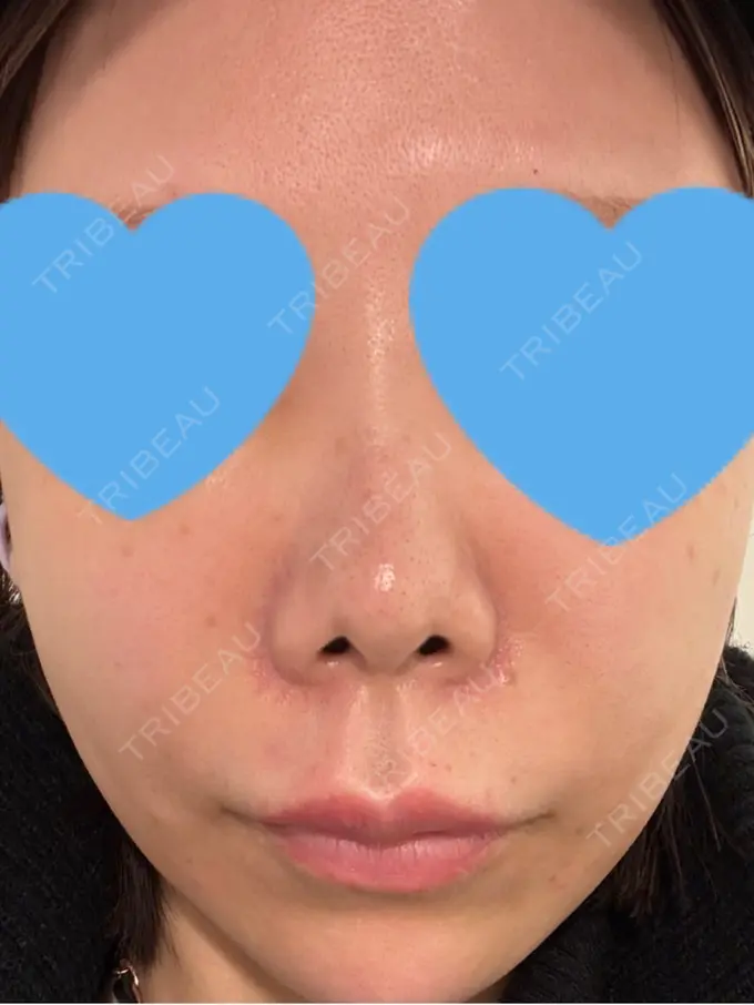 ボトックス（あご） / ボトックス（口角） / ボトックス（眉間） / ボトックス（目尻） / ボトックス（額） / ボトックス（人中） / その他（目元） eクリニック 岡山院 DAY 0 メイン用