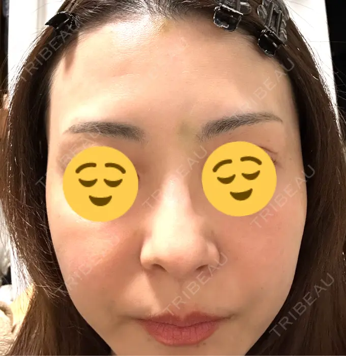 ボトックス（眉間） / ボトックス（額） TCB東京中央美容外科 三島院 DAY 2 メイン用