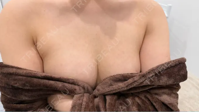 豊胸（脂肪注入） MYCLI【マイクリ】大阪・梅田院 AFTER メイン用