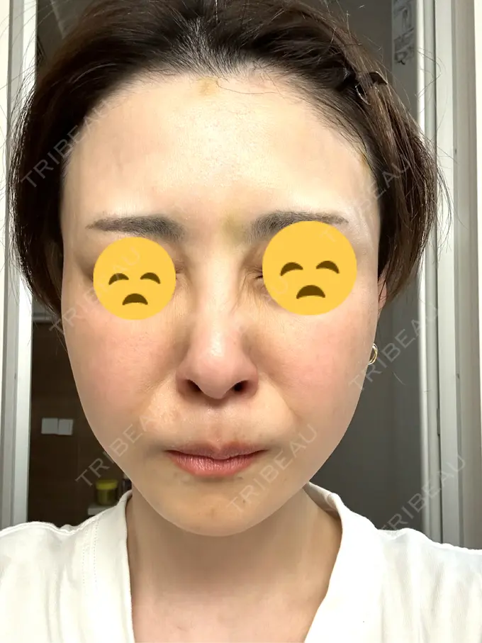 ボトックス（眉間） / ボトックス（額） TCB東京中央美容外科 三島院 DAY 3 メイン用