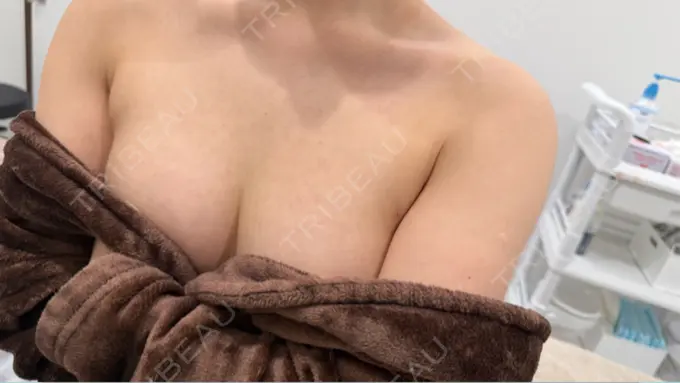 豊胸（脂肪注入） MYCLI【マイクリ】大阪・梅田院 DAY 70 メイン用