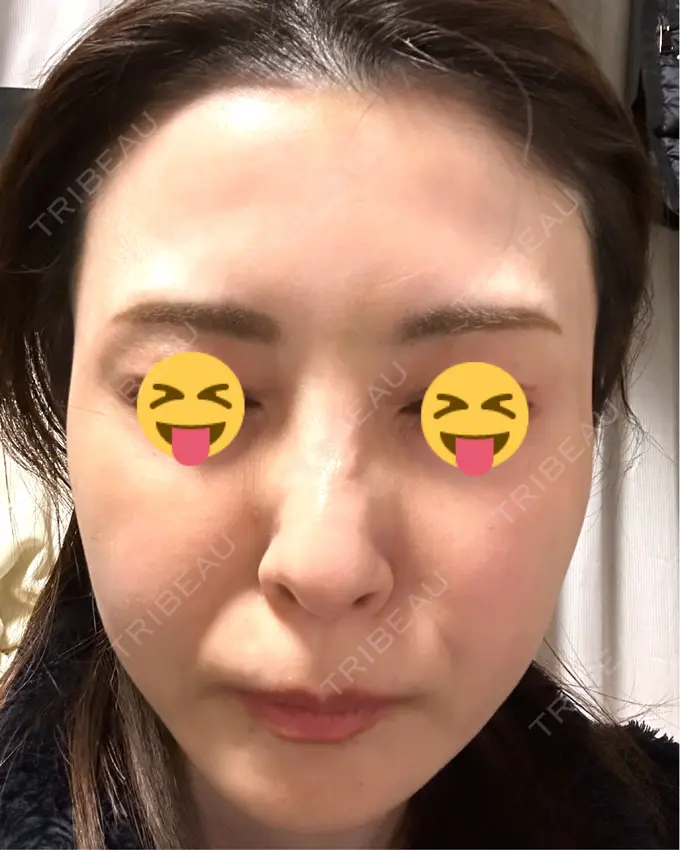 ボトックス（眉間） / ボトックス（額） TCB東京中央美容外科 三島院 DAY 5 メイン用