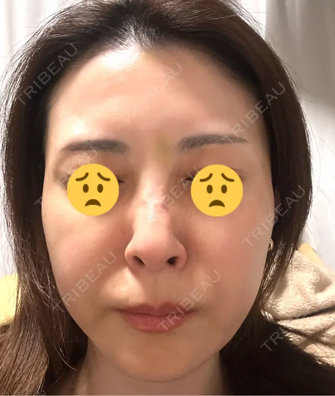 ボトックス（眉間） / ボトックス（額） TCB東京中央美容外科 三島院 DAY 6 メイン用