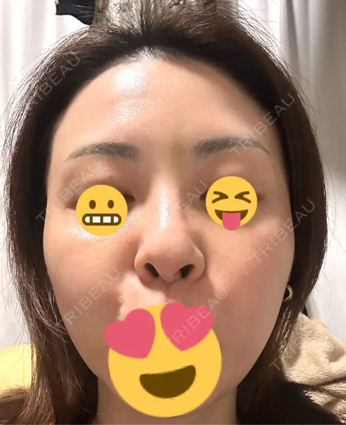 ボトックス（眉間） / ボトックス（額） TCB東京中央美容外科 三島院 DAY 7 メイン用