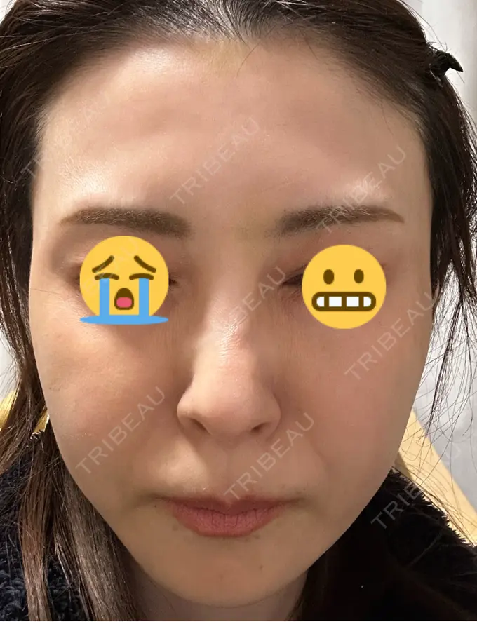 ボトックス（眉間） / ボトックス（額） TCB東京中央美容外科 三島院 DAY 8 メイン用