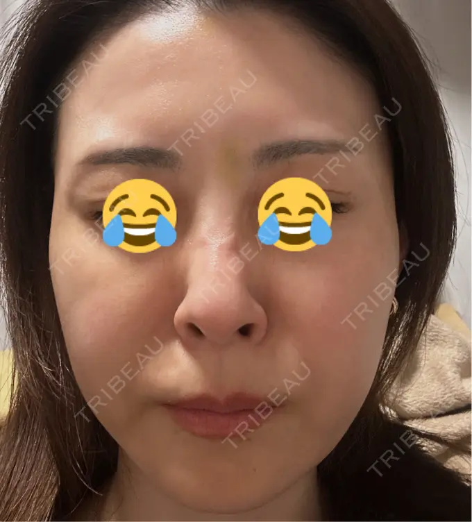 ボトックス（眉間） / ボトックス（額） TCB東京中央美容外科 三島院 DAY 9 メイン用