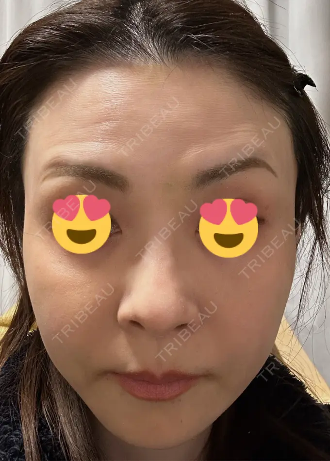 ボトックス（眉間） / ボトックス（額） TCB東京中央美容外科 三島院 AFTER メイン用