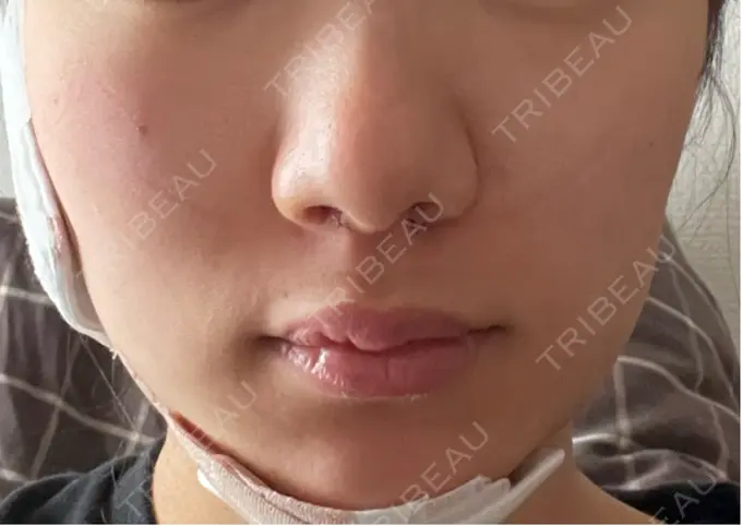 糸リフト / 脂肪吸引（顔） Otus Clinic 【オータスクリニック】 DAY 1 メイン用