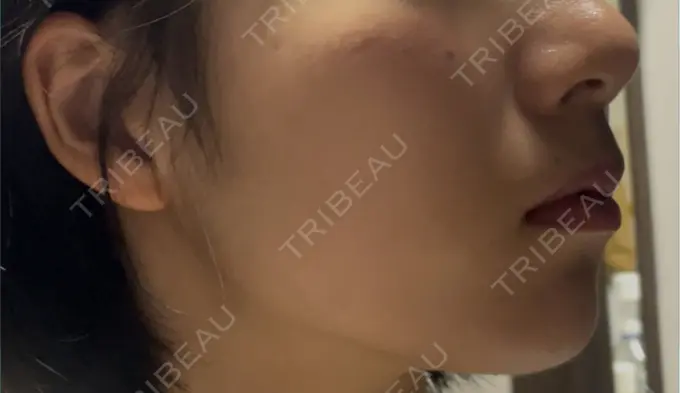 糸リフト / 脂肪吸引（顔） Otus Clinic 【オータスクリニック】 AFTER メイン用