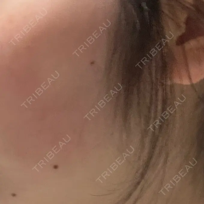 インモード 東京美容皮膚科アロエクリニック池袋 AFTER メイン用