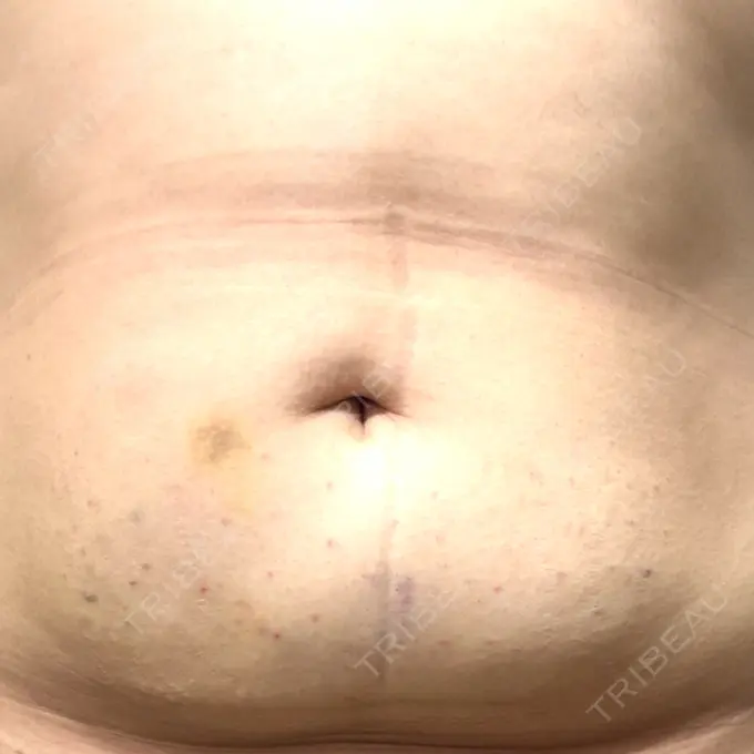 脂肪溶解注射（お腹） FIG CLINIC DAY 0 メイン用