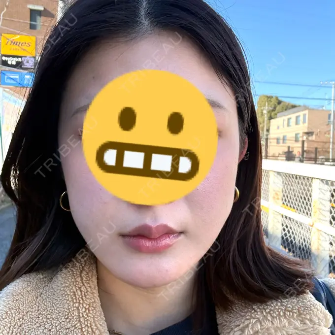 糸リフト / 脂肪吸引（顔） 下北沢スキンクリニック AFTER メイン用