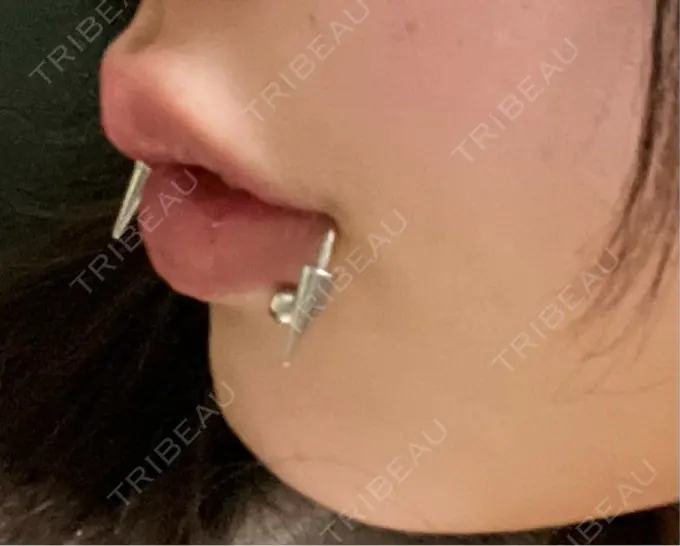 ヒアルロン酸注入（唇） / ボトックス（口角） ルラ美容クリニック 大阪本院 DAY 13 メイン用