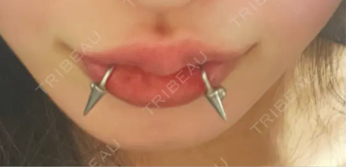 ヒアルロン酸注入（唇） / ボトックス（口角） ルラ美容クリニック 大阪本院 DAY 14 メイン用