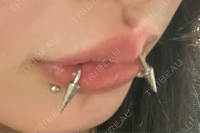 ヒアルロン酸注入（唇） / ボトックス（口角） ルラ美容クリニック 大阪本院 DAY 14 メイン用