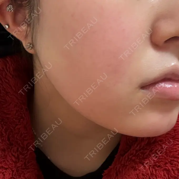 脂肪吸引（顔） / 脂肪吸引（二の腕） / ジョールファット除去 / 脂肪吸引（肩） 湘南美容クリニック Regno 銀座院 DAY 31 メイン用