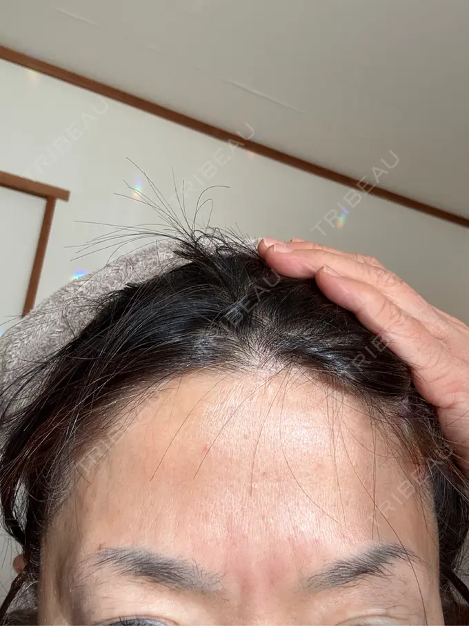 ボトックス（眉間） / ボトックス（額） BiBiクリニック AFTER メイン用