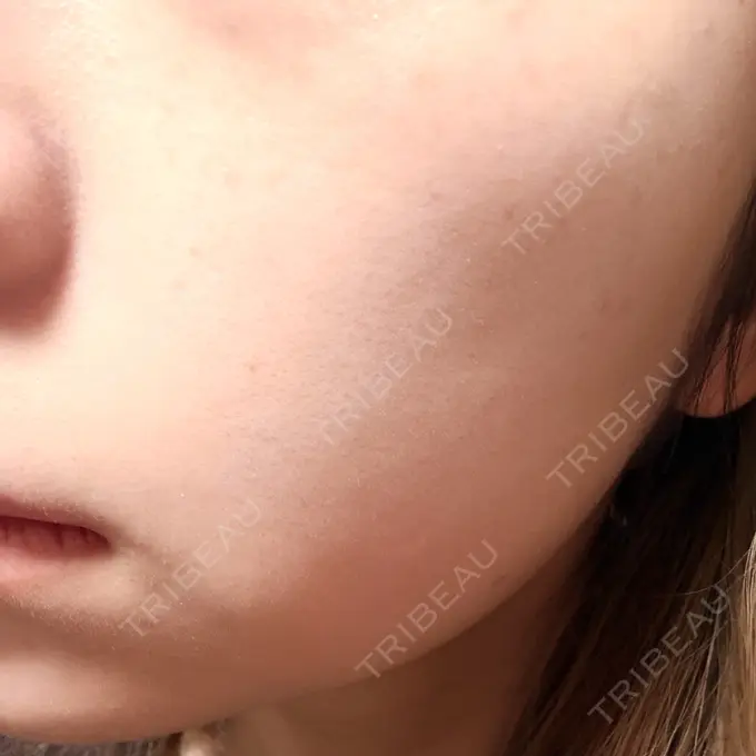 ルメッカ 博多美容外科/美容皮膚科 ビラビューティークリニック DAY 14 メイン用