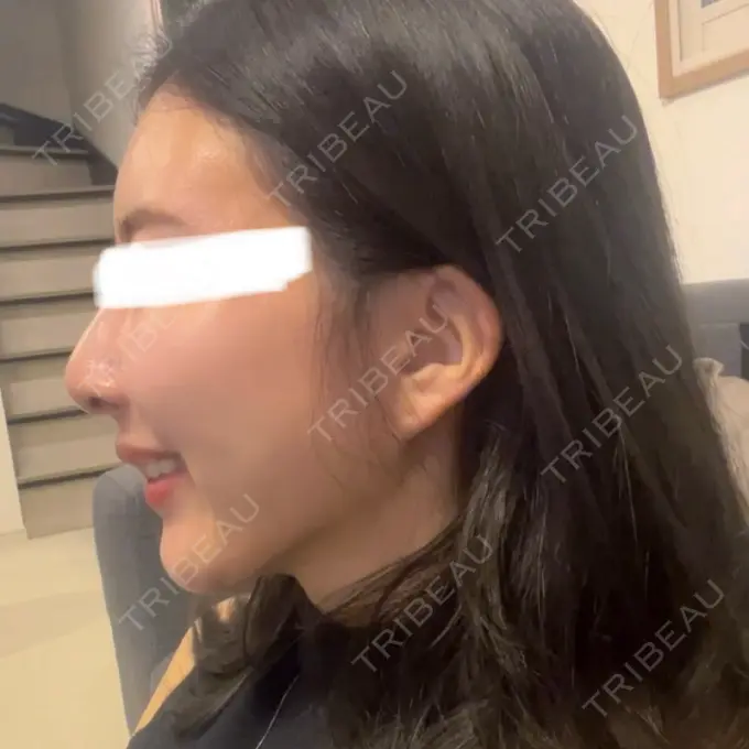 糸リフト / 脂肪吸引（顔） / 額を丸く / 脂肪注入（額） / ジョールファット除去 / 脂肪吸引注射（顔） / 脂肪注入（輪郭） / 美容点滴・美容注射（疲労回復） / その他 SEA CLINIC（シークリニック） DAY 55 メイン用