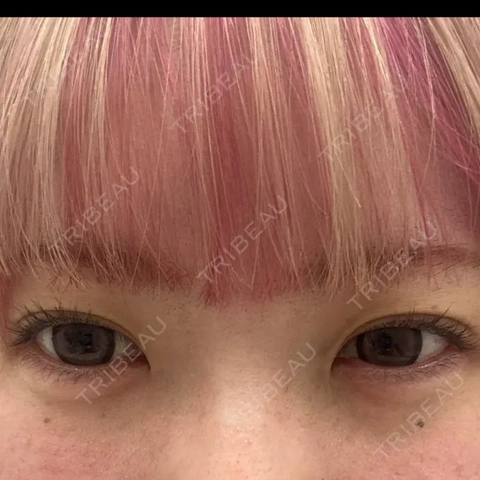 ヒアルロン酸注入（涙袋） YBC横浜美容外科 立川院 DAY 0 メイン用