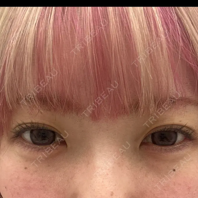 ヒアルロン酸注入（涙袋） YBC横浜美容外科 立川院 AFTER メイン用