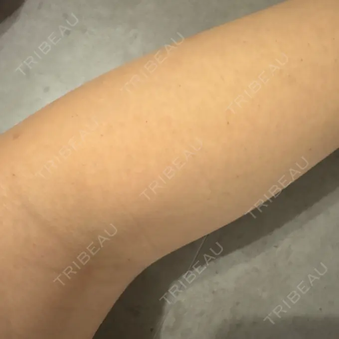 医療脱毛（全身） おおかみ美容のクリニック 横浜院 DAY 4 メイン用