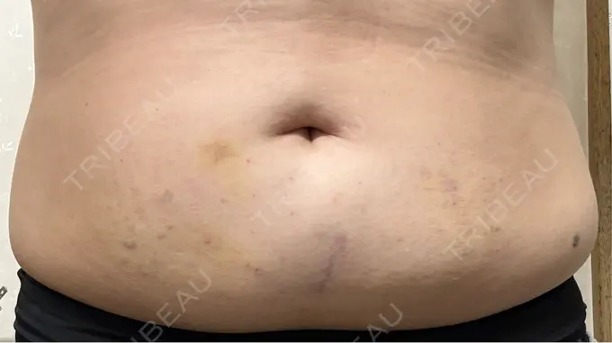 脂肪溶解注射（お腹） FIG CLINIC DAY 1 メイン用