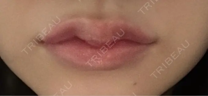 ヒアルロン酸注入（唇） 宇都宮竹内クリニック DAY 0 メイン用