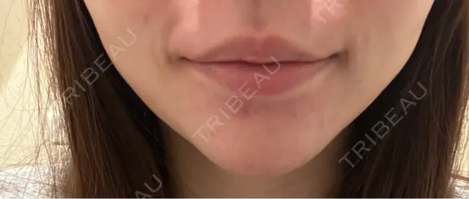 ボトックス（あご） 湘南美容クリニック 名古屋院 AFTER メイン用