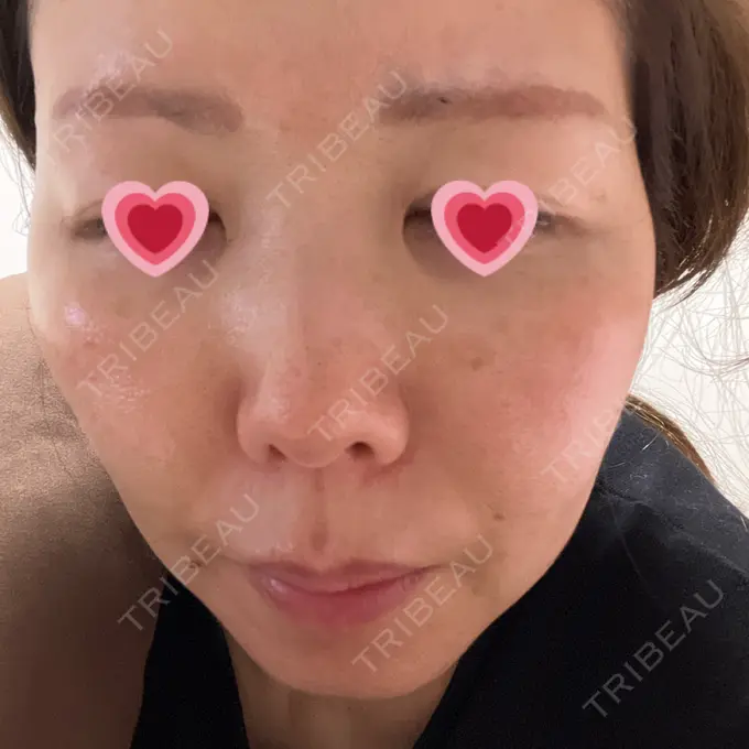 肌育注射（ジュベルックなど） BAO CLINIC 梅田院 AFTER メイン用