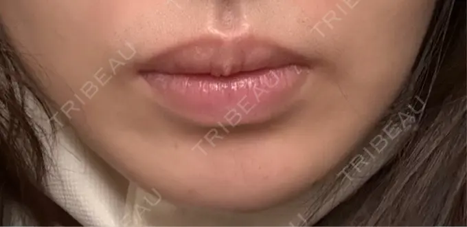 ヒアルロン酸注入（あご） 新未来クリニック DAY 0 メイン用