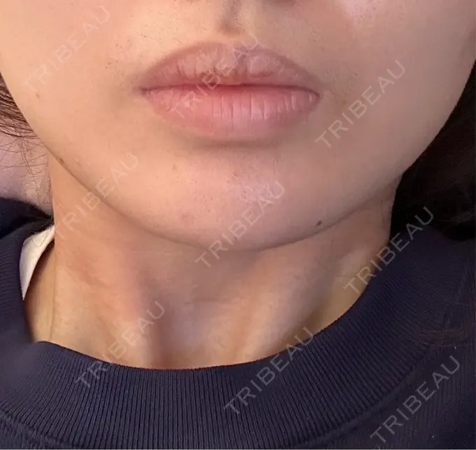 ヒアルロン酸注入（あご） 新未来クリニック AFTER メイン用