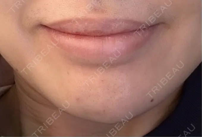 ヒアルロン酸注入（あご） 新未来クリニック DAY 2 メイン用