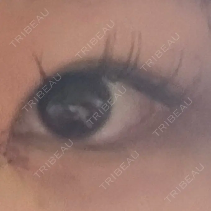 目頭切開 つだ美容外科クリニック AFTER メイン用