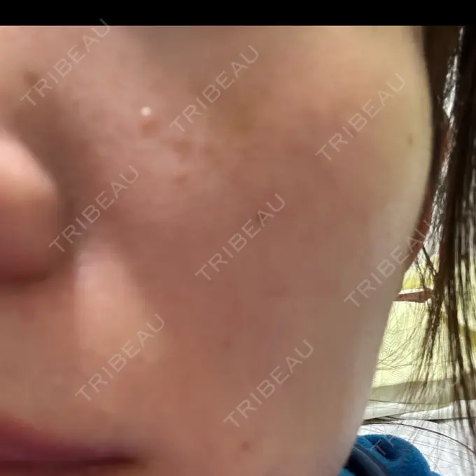 スネコス ルラ美容クリニック 仙台院 / ルラスキンクリニック 仙台院 AFTER メイン用