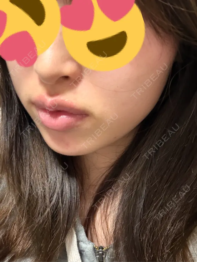 ボトックス（あご） / ボトックス（エラ・小顔） / ボトックス（口角） ルラ美容クリニック 神戸院 DAY 4 メイン用