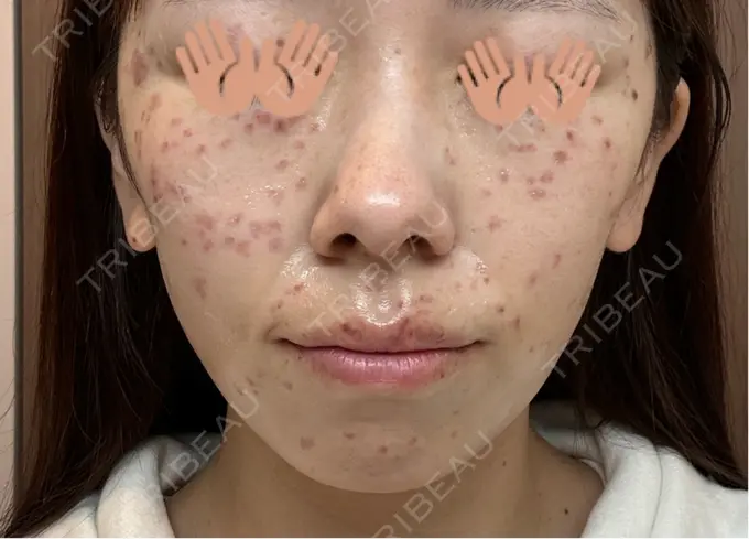 ピコレーザートーニング（美白・肝斑） / ピコスポット 東京シルククリニック 東京神田院 DAY 1 メイン用