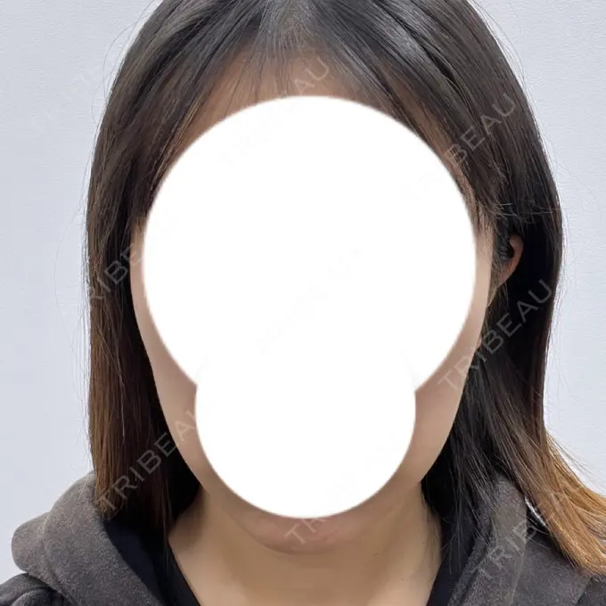 インモード 東京美容皮膚科アロエクリニック池袋 DAY 0 メイン用