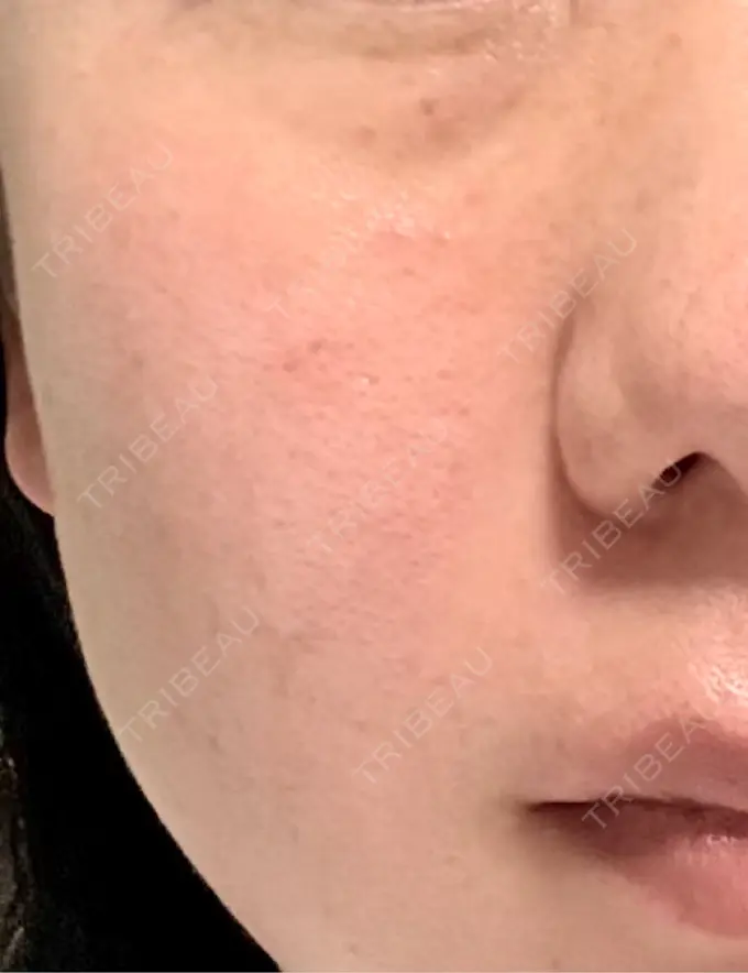 光治療（フォトフェイシャルなど） 仙台TAクリニック AFTER メイン用