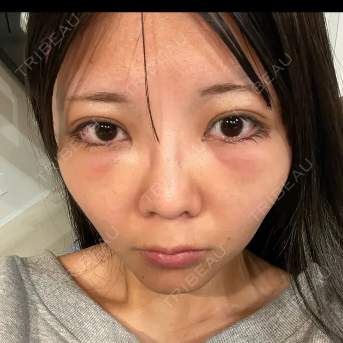 クマ治療 あじまビューティークリニック DAY 1 メイン用