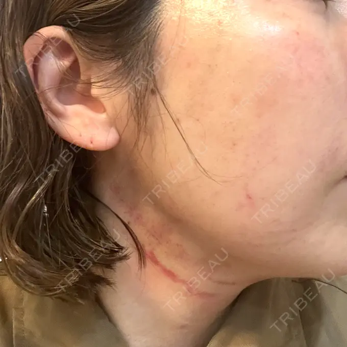 ピコレーザートーニング（美白・肝斑） / ピコフラクショナルレーザー（毛穴・ニキビ跡） / インモード 東京美容皮膚科アロエクリニック池袋 DAY 0 メイン用