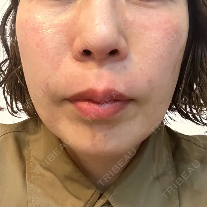 ピコレーザートーニング（美白・肝斑） / ピコフラクショナルレーザー（毛穴・ニキビ跡） / インモード 東京美容皮膚科アロエクリニック池袋 DAY 0 メイン用