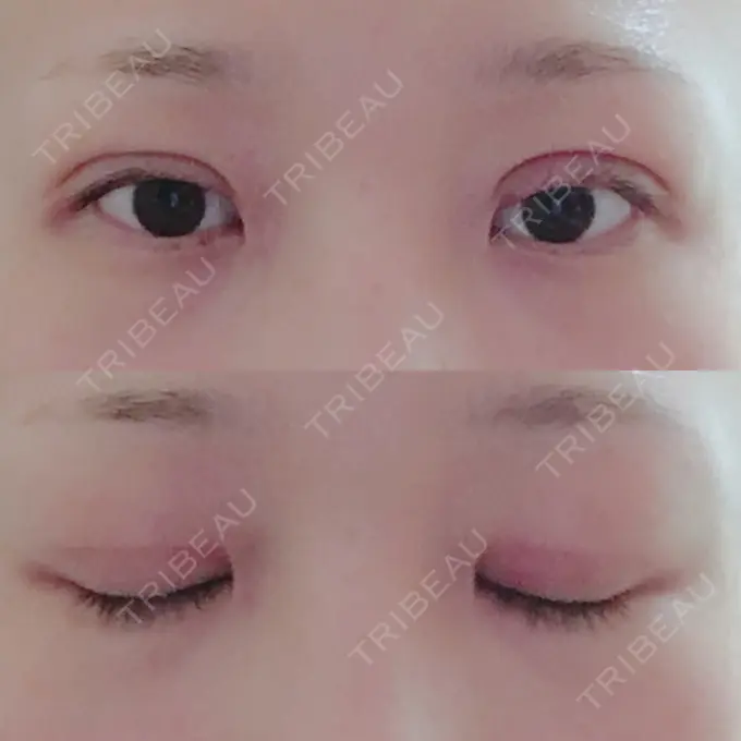 二重切開 城本クリニック 豊橋院 DAY 48 メイン用