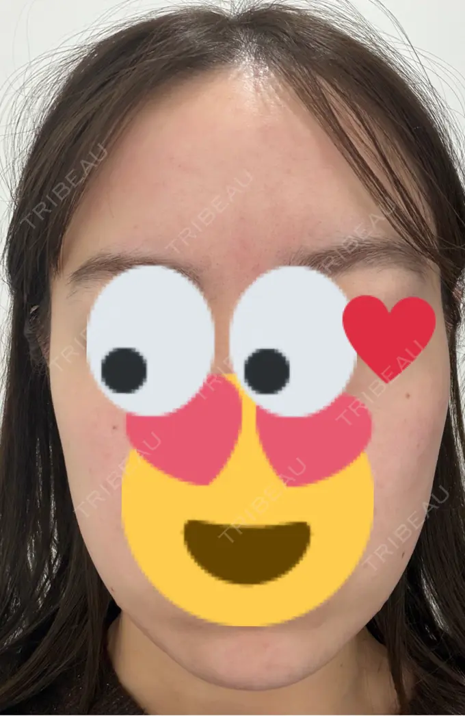 医療脱毛（顔） VERDE CLINIC お茶の水（ベルデクリニックお茶の水） AFTER メイン用