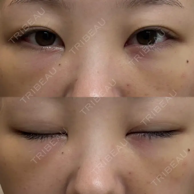 クマ治療 / 脂肪注入（目の下） 湘南美容クリニック 千葉センシティ院 DAY 6 メイン用