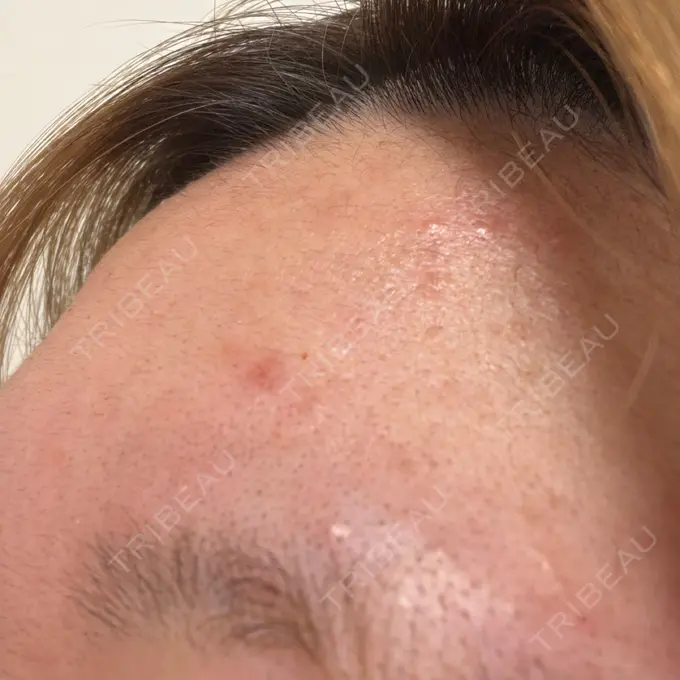 ボトックス（眉間） / ボトックス（額） / その他（鼻） TCB東京中央美容外科 姫路院 DAY 0 メイン用